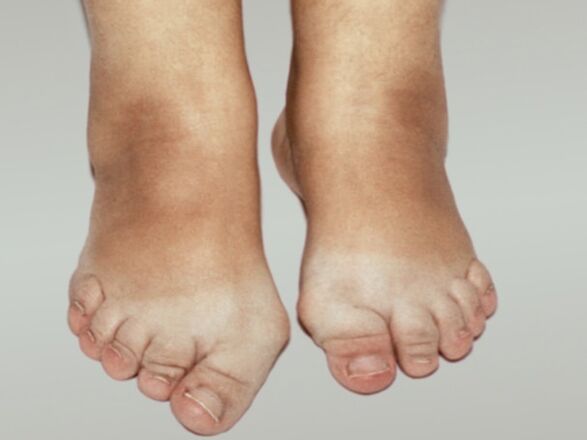 Arthrose du pied avec déformation sévère des orteils