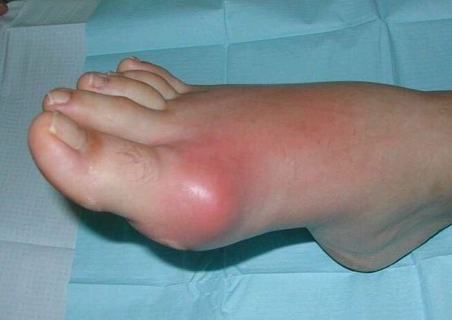 Tableau clinique de l'arthrite du pied - gonflement et inflammation