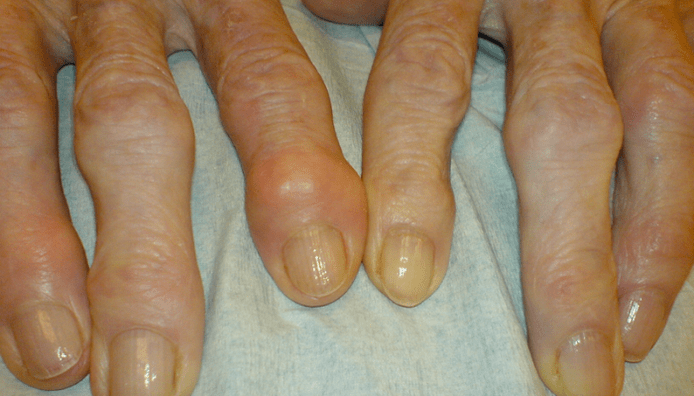 douleur dans les articulations des doigts avec arthrose