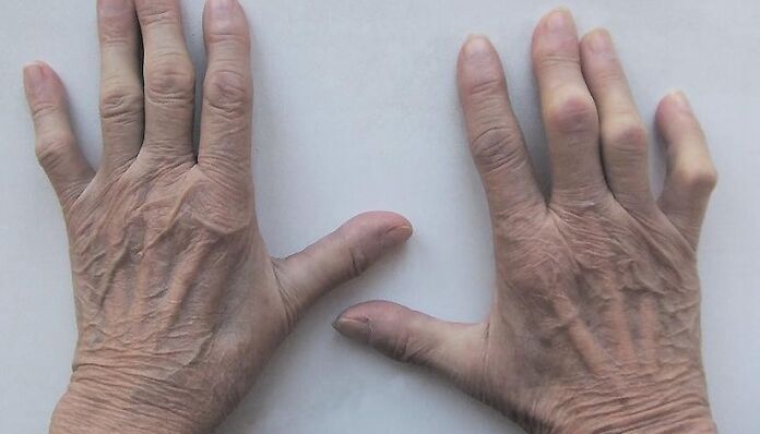 douleur dans les articulations des doigts