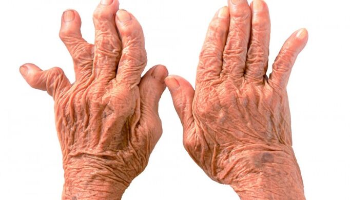 la polyarthrite rhumatoïde comme cause de douleurs dans les articulations des doigts