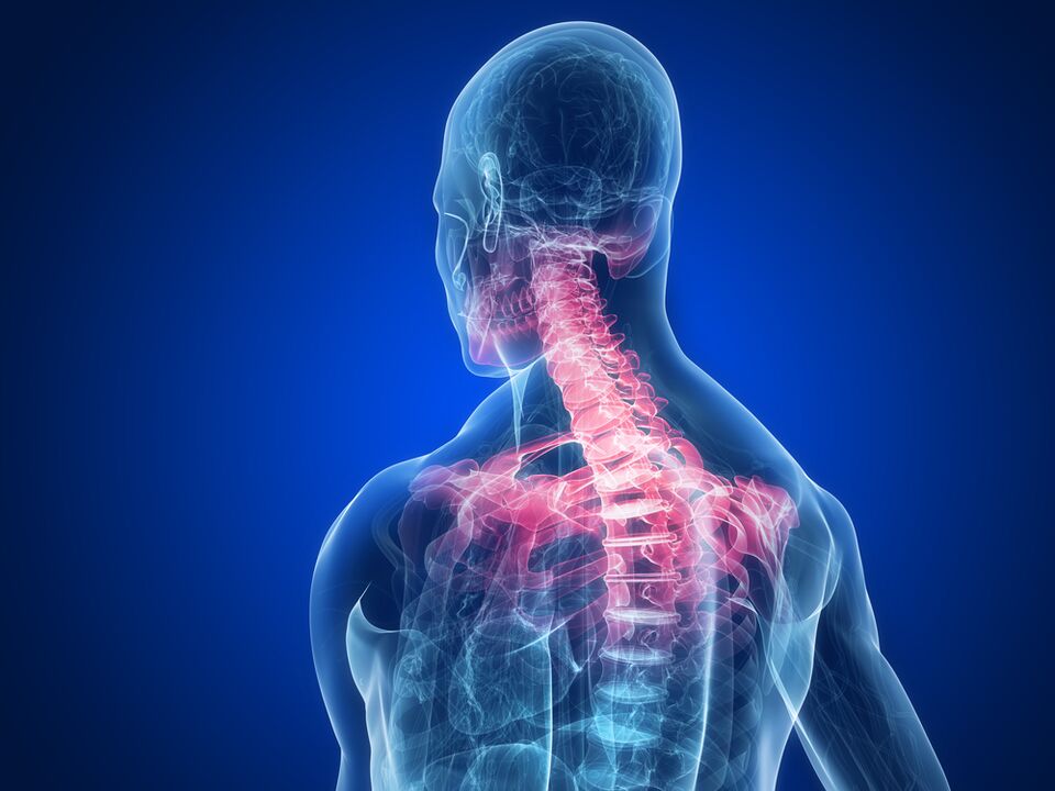 la spondylarthrose comme cause de douleur entre les omoplates