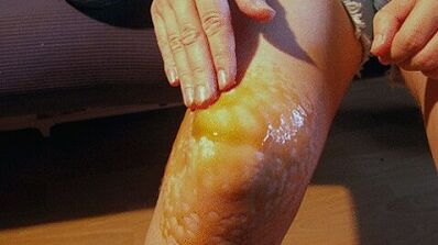 Frottements pour le traitement de l'arthrose de l'articulation du genou