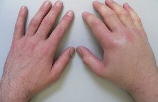 arthralgie comme cause de douleur dans les articulations des doigts