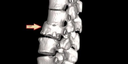 pathologie de la colonne vertébrale comme cause de maux de dos