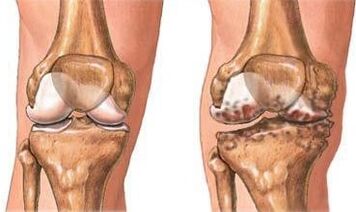 Arthrose du genou