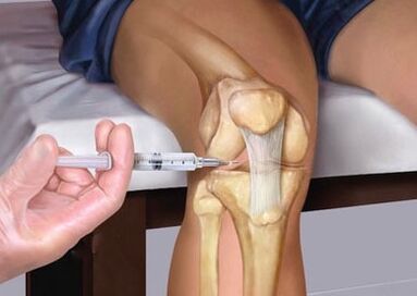 Injection dans l'articulation
