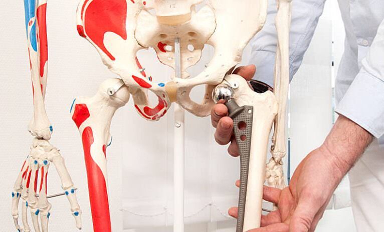 arthroplastie de la hanche pour la douleur