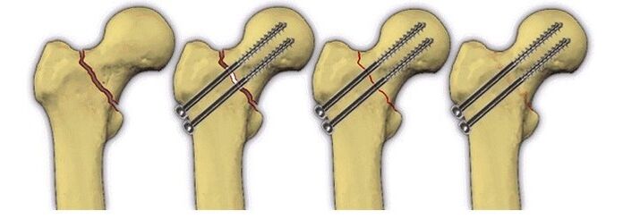 fixation du corps osseux avec des broches pour la douleur dans l'articulation de la hanche