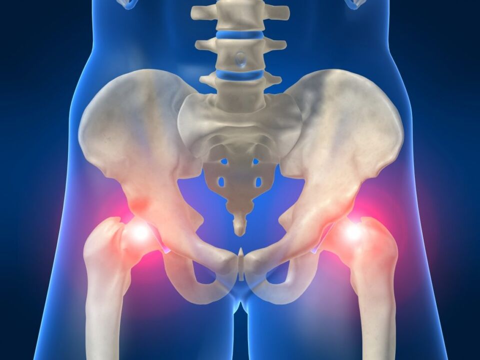 Dans la spondylarthrite ankylosante, des douleurs bilatérales au niveau de l'articulation de la hanche sont gênantes