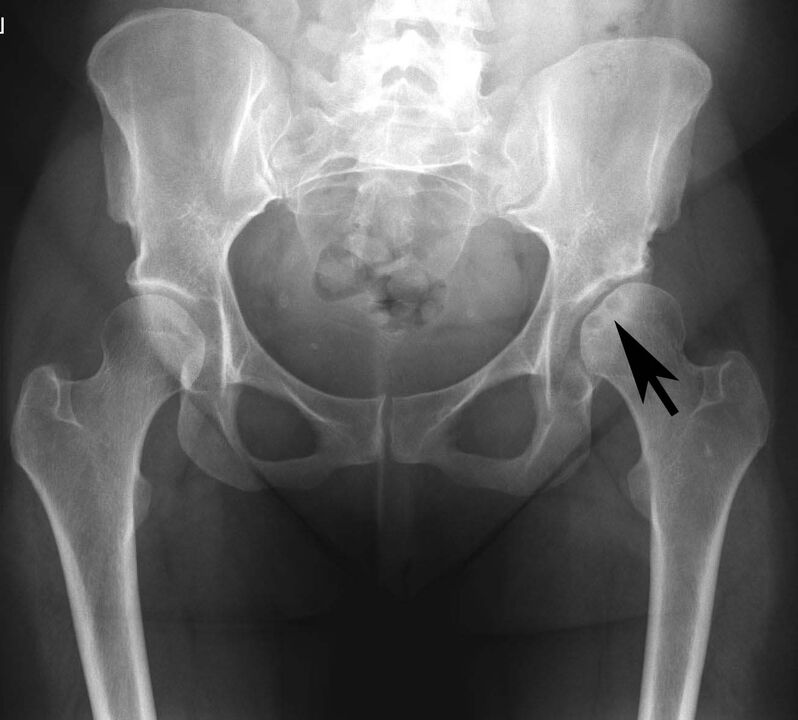 Dépôt de sels de calcium dans l'articulation de la hanche avec pseudogoutte aux rayons X