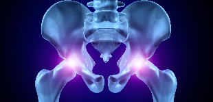 l'arthrose de la hanche